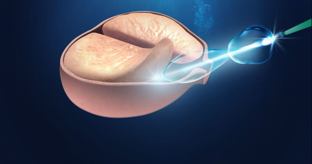 HoLEP: Cirurgia a Laser Avançada para HPB